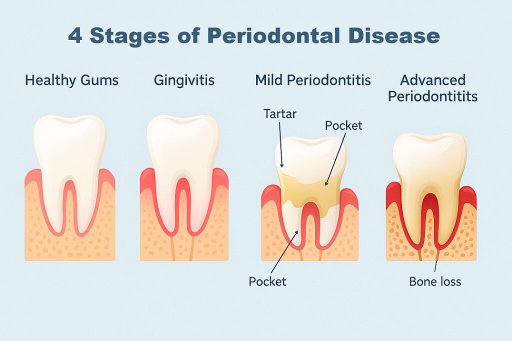 4 stages of periodontal disease 1024x682