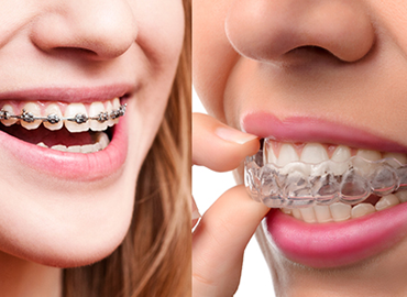 braces and aligners