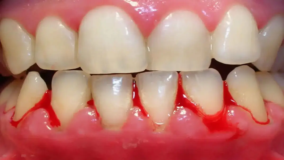 resize bleeding gums vanilla