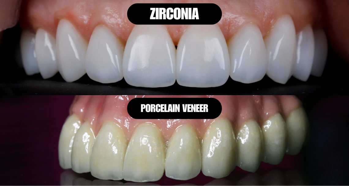 zirconia vs porcelain veneer