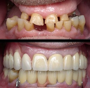 full mouth rehab