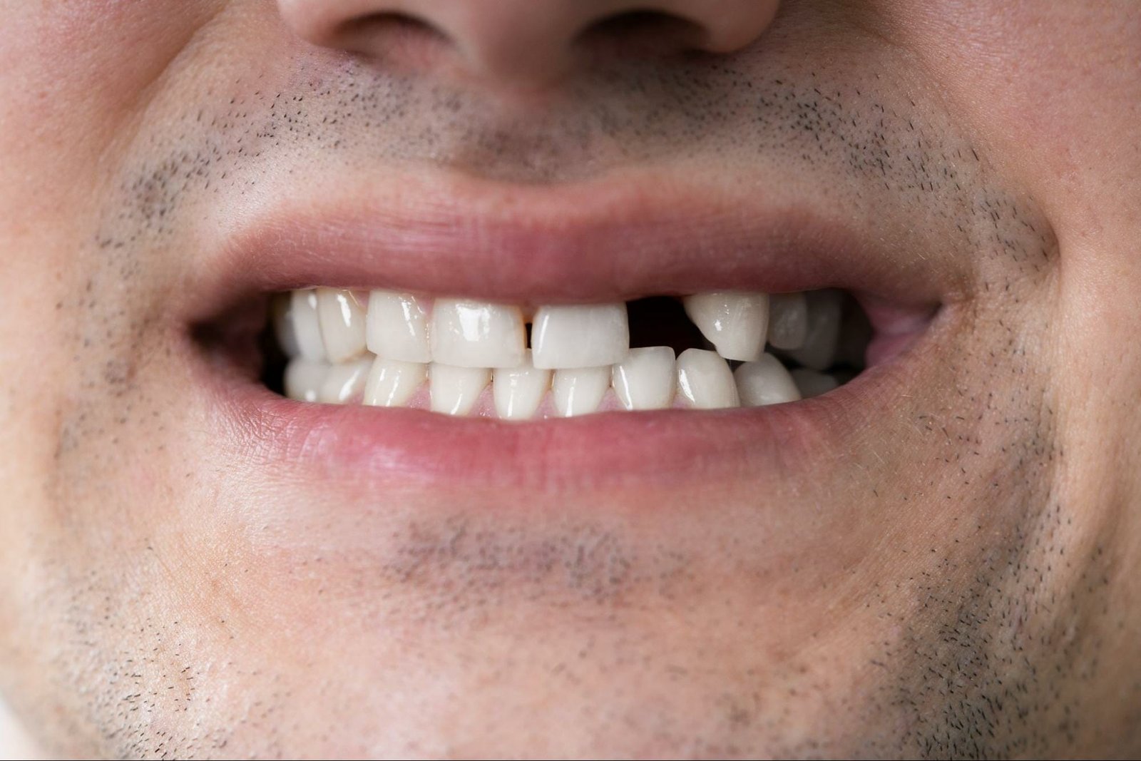 missing a front tooth