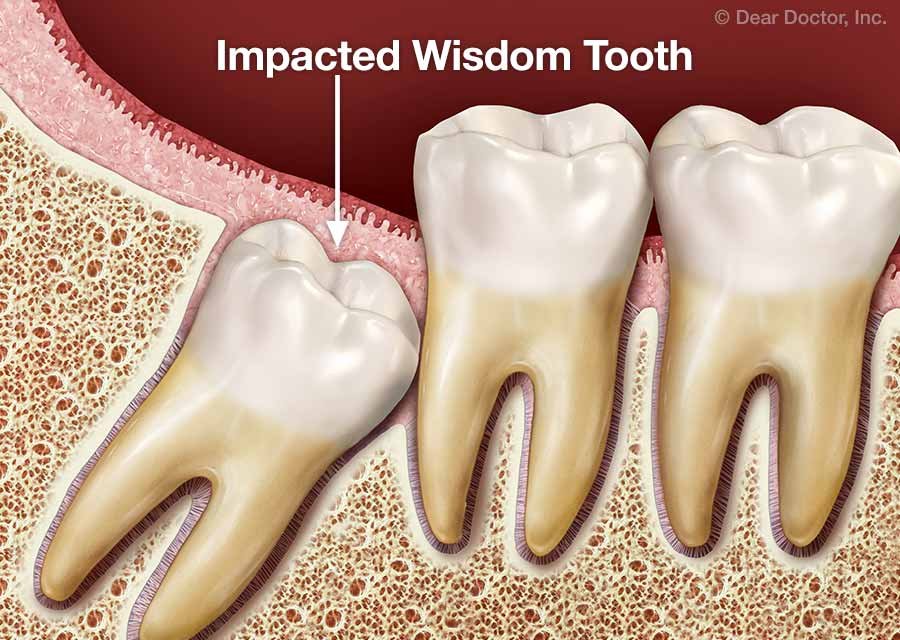 myths extraction wisdom teeth 1 impacted wisdom tooth