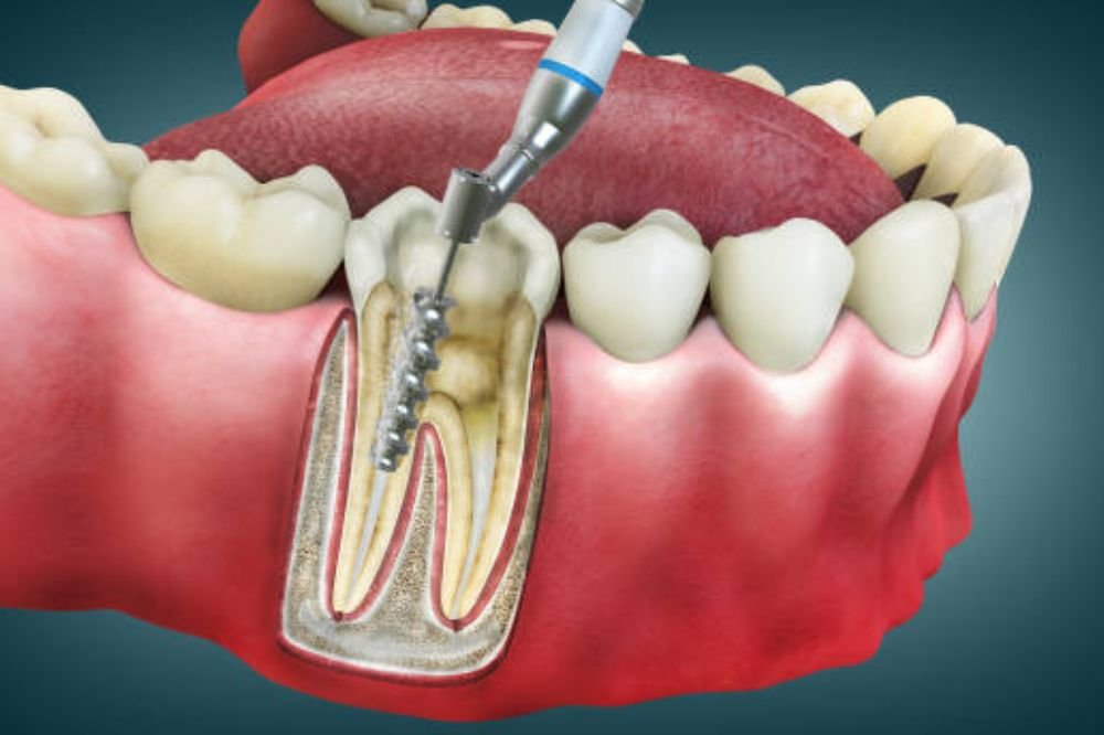 root canal treatment types which one do you need