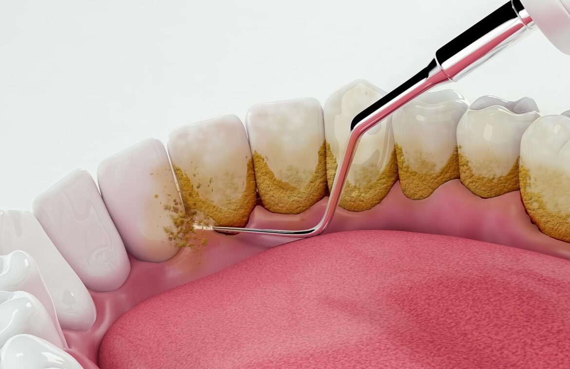 teeth scalling and polishing 2 1170x759