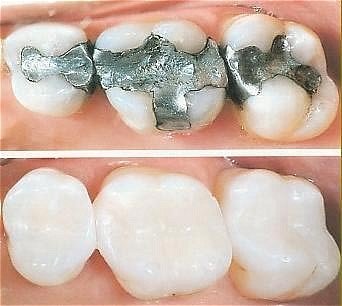 tooth colored fillings