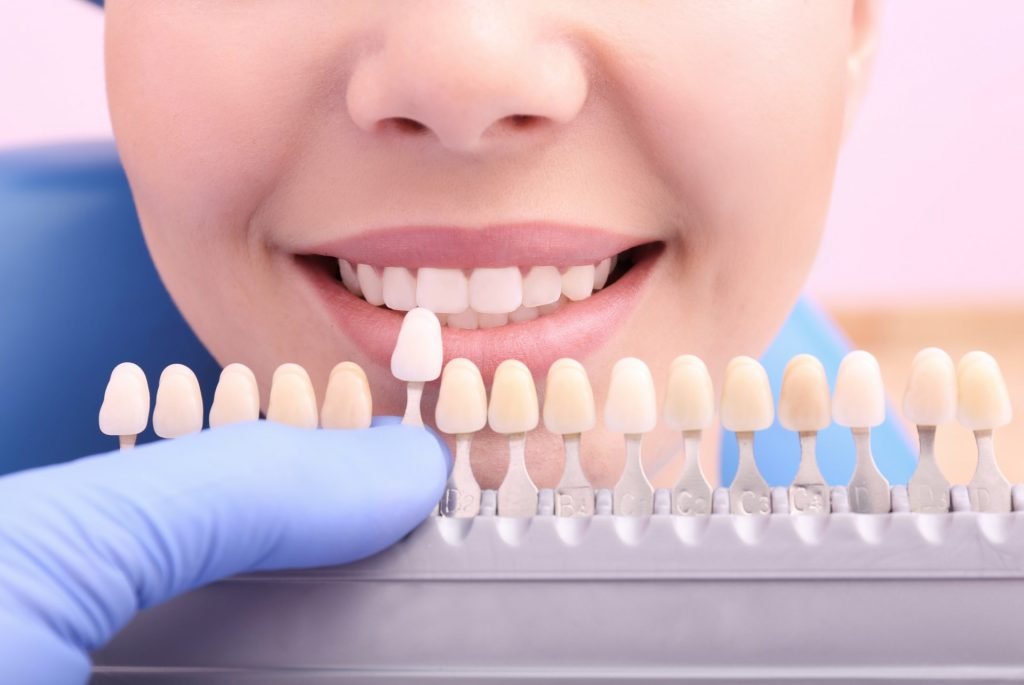 tooth coloured filling